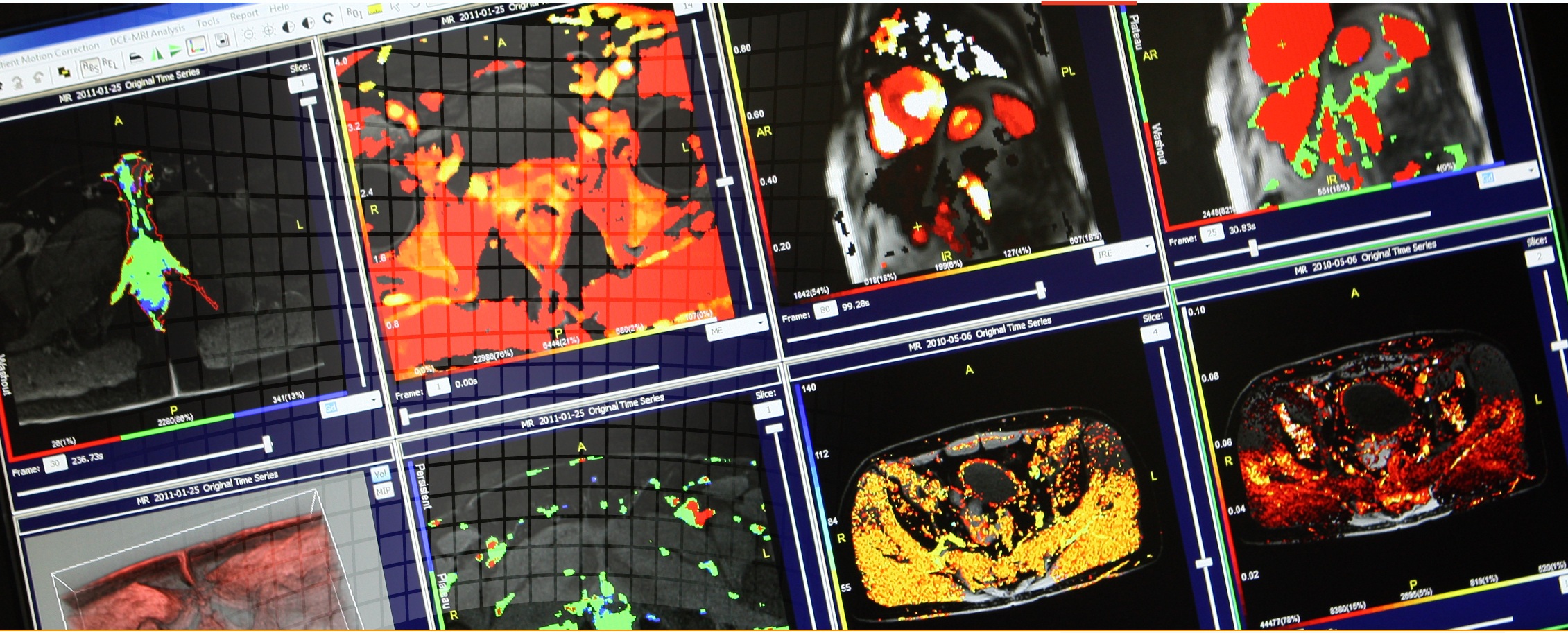 prostate-heart