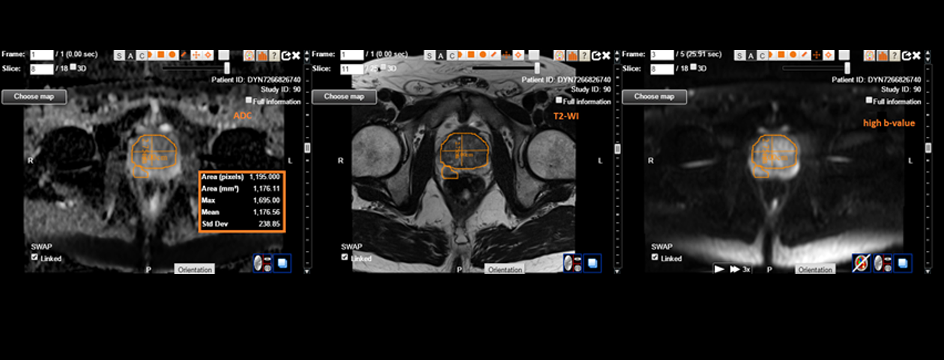 Banner-Prostatecancer
