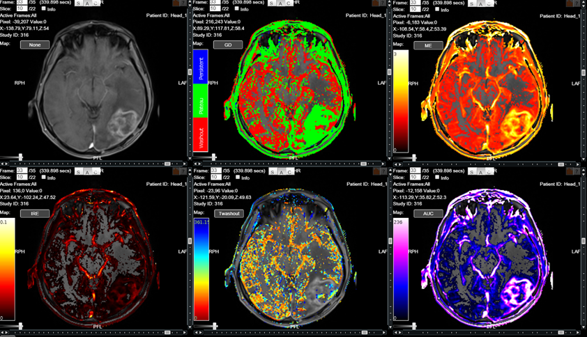 Glioblastoma-IAG