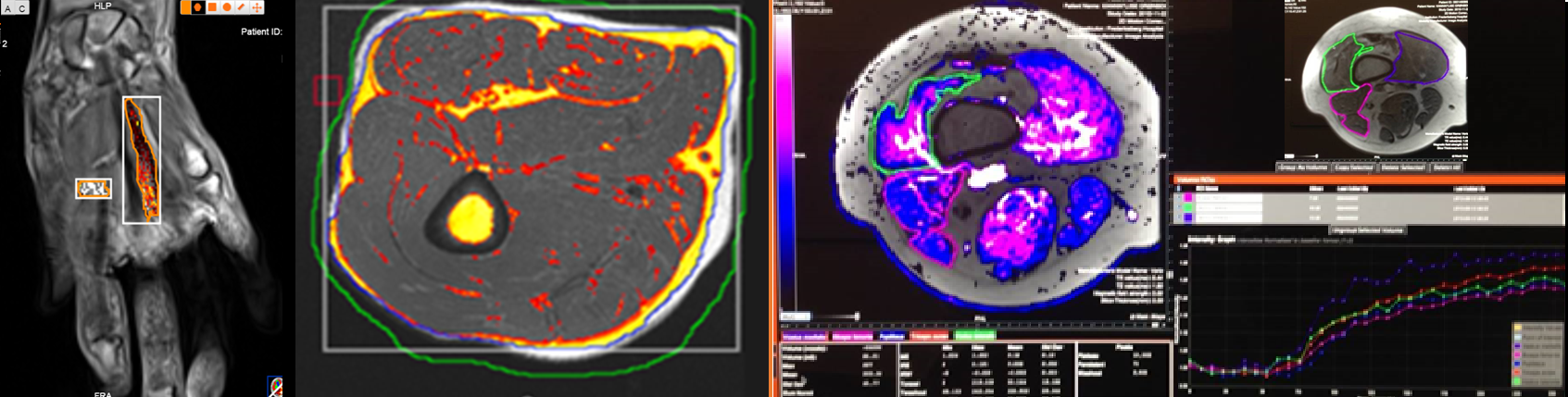 Muscle-MRI