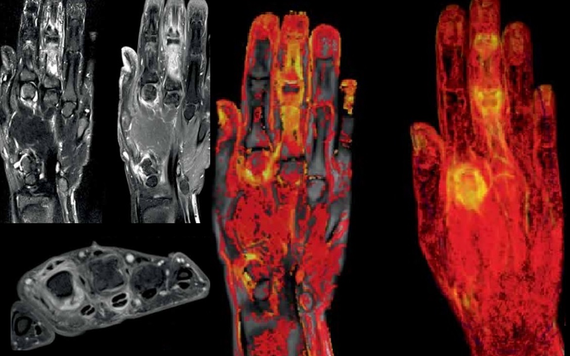 Psoriasis-Dynamika-MRI