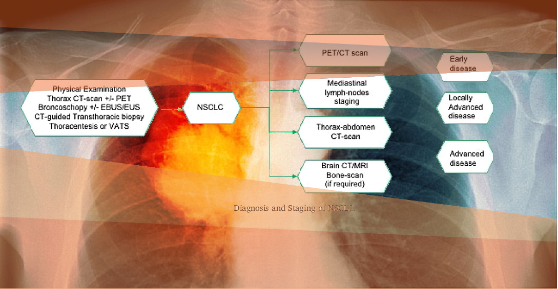 Lung cancer