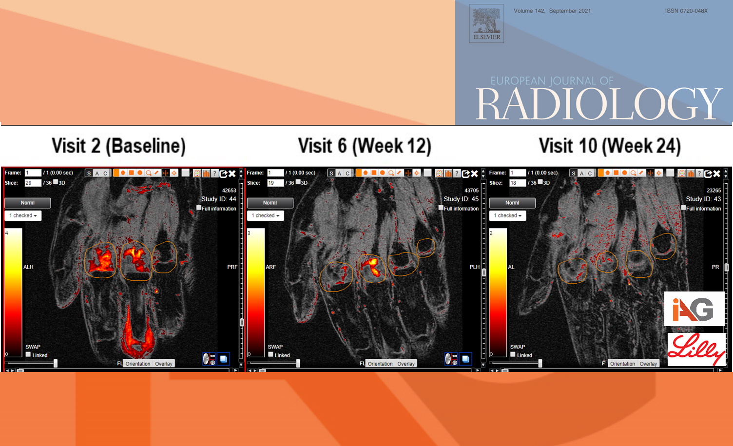IAG-Lilly-Rheum